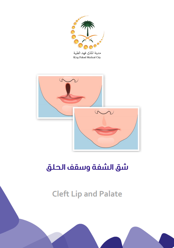 Cleft lip and palate.PNG