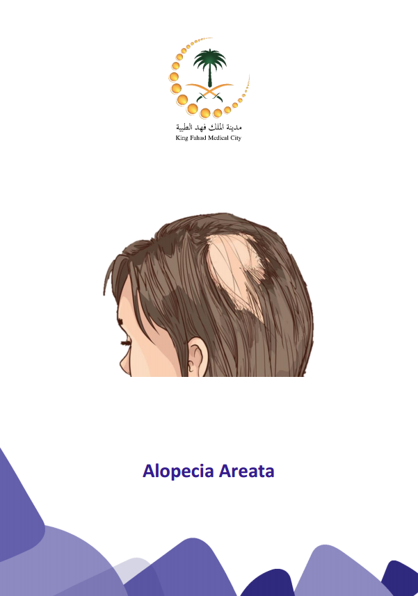 alopecia areta.PNG