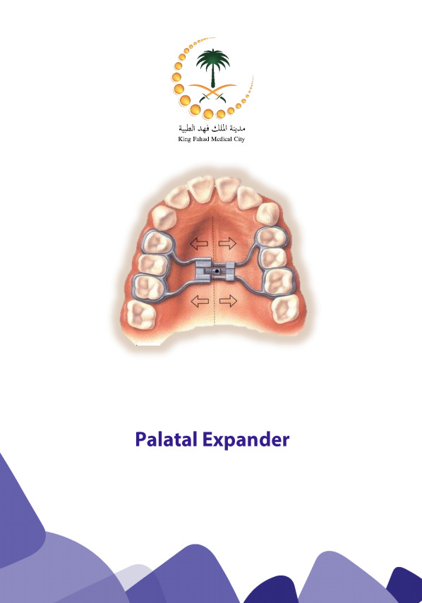 palatal expander.PNG